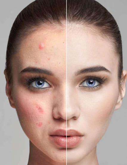 http://www.phoenixcosmeticcentre.com/acne-and-acne-marks-scars-treatment
